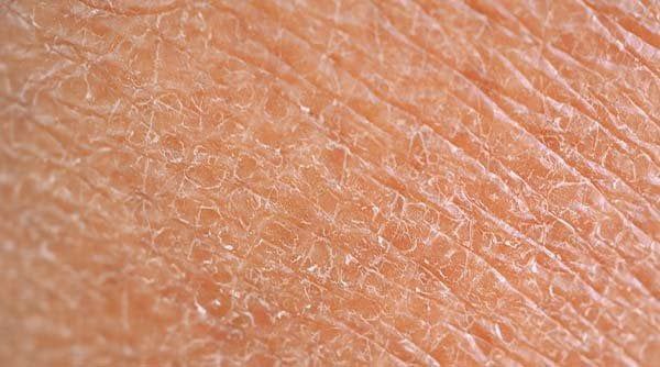 Dry Skin